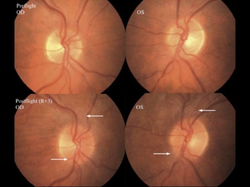 Pre-flight and Post-flight funduscopic images from an astronaut after a 6-month mission.