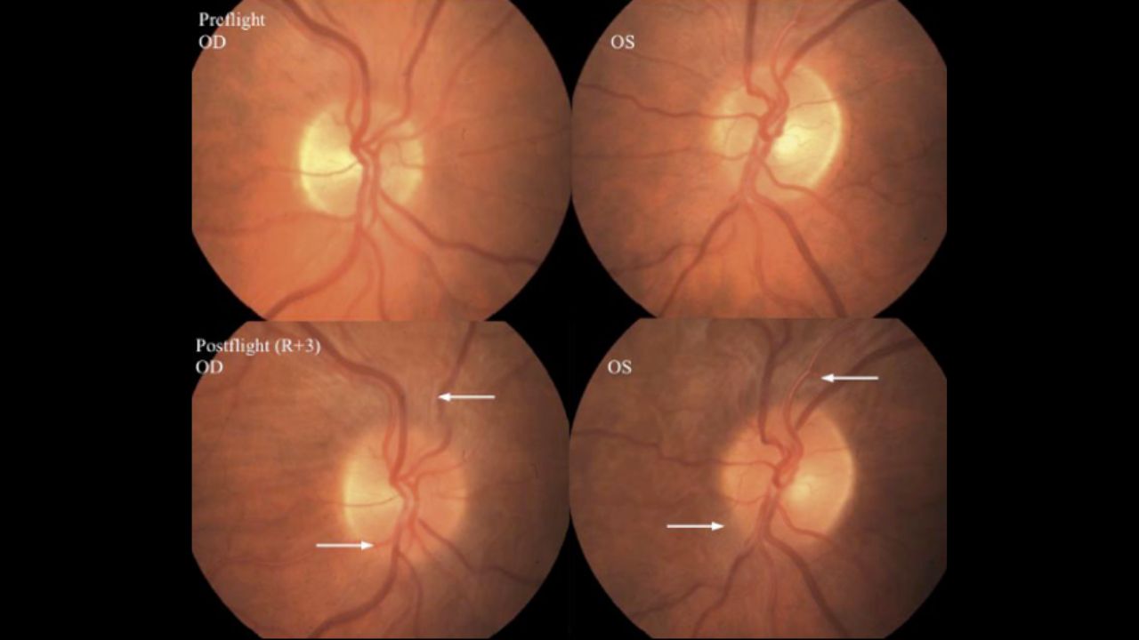 Examining The Effects Of Microgravity On Human Eyesight